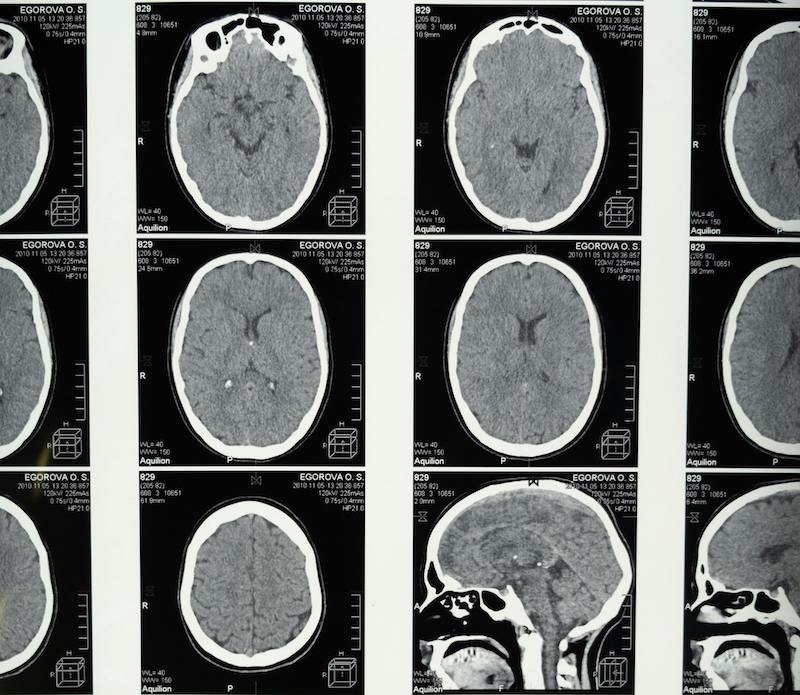 Concussion and TBI Treatment