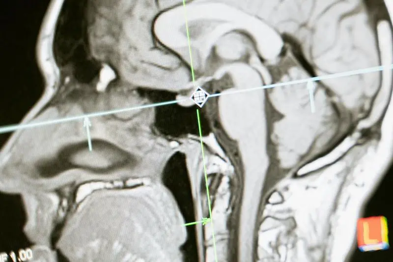 Neurofeedback Therapy for Stroke Recovery